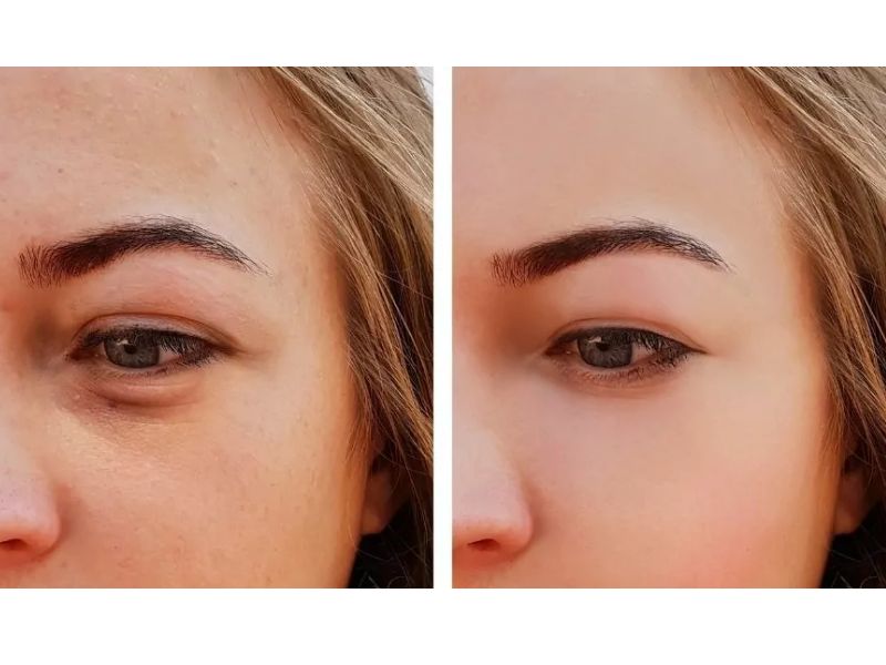 Ojos hinchados