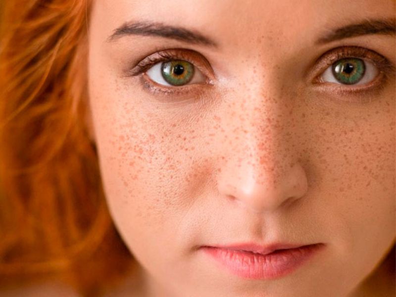 pecas en la cara