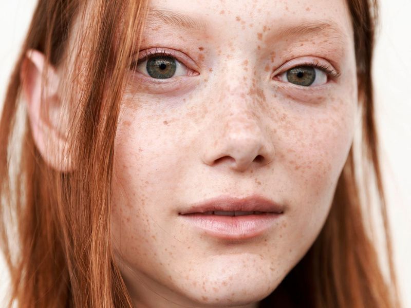 pecas en la cara